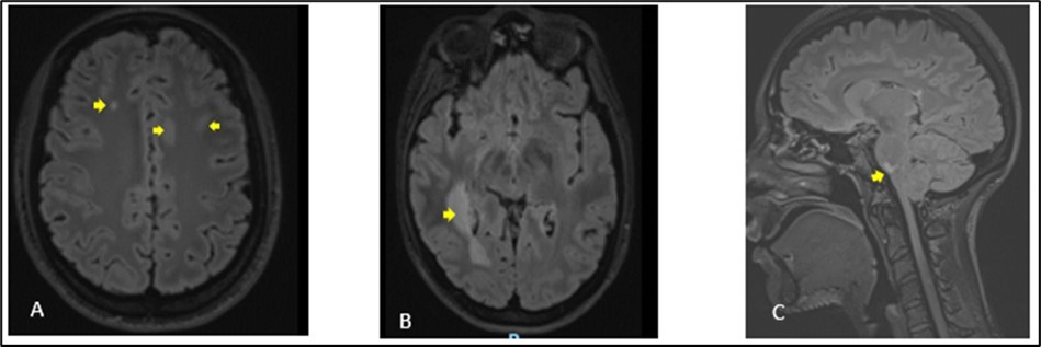 Cerebral MRI in FLAIR sequences showing multiple hyperintense lesions at the supratentorial (A, B) and infratentorial (C) levels. The largest supratentorial lesion (B) is opposite the right paraventricular white matter, at the level of the posterior horn and measures 55 x 17 mm axially. Presence of a lesion of pons (C) of 6.5 mm.