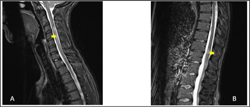 Sagittal T2-weighted spine MRI showing at cervical level (A), a spontaneous hyperintense lesion of 5 cm from C3 to C6 and at thoracic level (B), a spontaneous hyperintense lesion of 1.5 cm from T11-T12