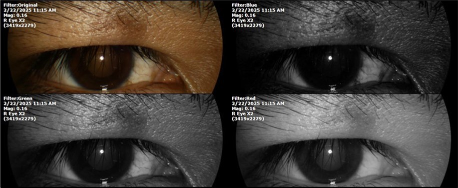 The mirror reflection of the affected (right) eye continues to improve.