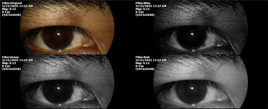 Mirror reflection of the affected eye (right side), with good appearance. This indicates that the transparent media of the eyeball (Cornea, anterior chamber, lens, and vitreous) are in good condition.