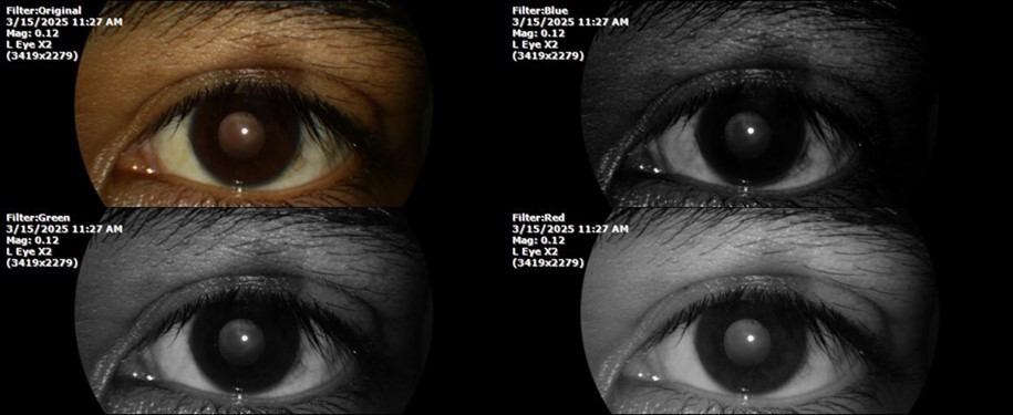 The photograph of the left eye shows a specular reflection without pathology data.