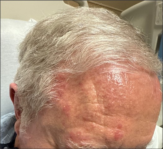 Journal of Ophthalmic Science - Herpes Zoster