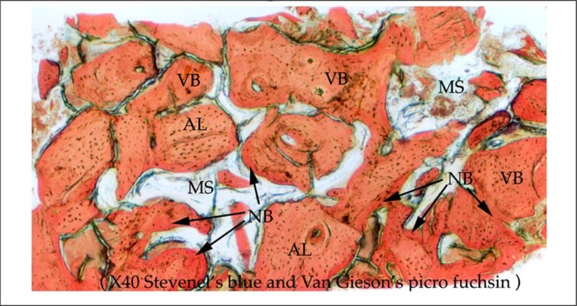 Figure 1. Medium power histology view. Extensive formation of mature vital bone. Note bridging between sheets of vital bone. VB: mature vital bone. AL: Allogeneic bone. MS: marrow space. NB: immature new bone. Original magnification x 40. Stevenel’s blue and Van Gieson’s picro fuchsin.